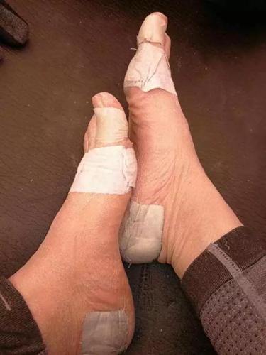 馮靜的腳受傷
